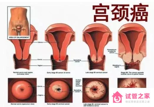 宮頸癌是什么原因導致的