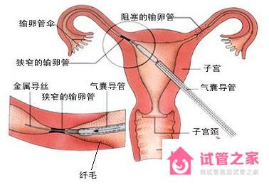 輸*管造影檢查前有什么準(zhǔn)備