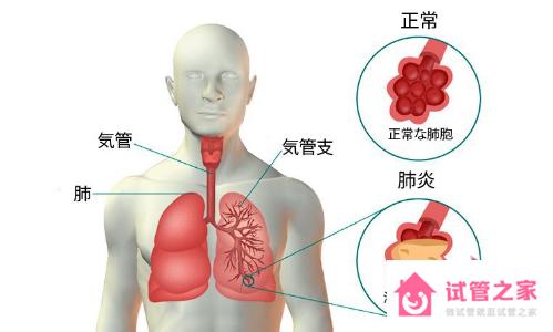 肺炎癥狀反復發(fā)作