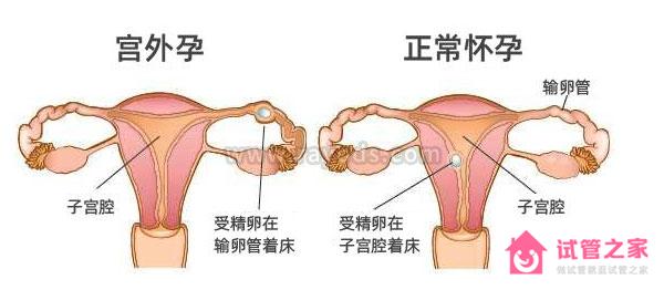 試管嬰兒出現(xiàn)宮外孕的幾種情況