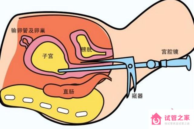 宮腔鏡手術后怎樣調養(yǎng)