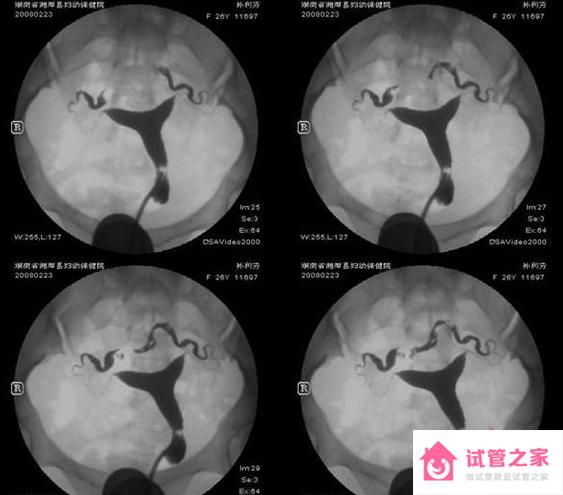 輸*管造影做還是不做