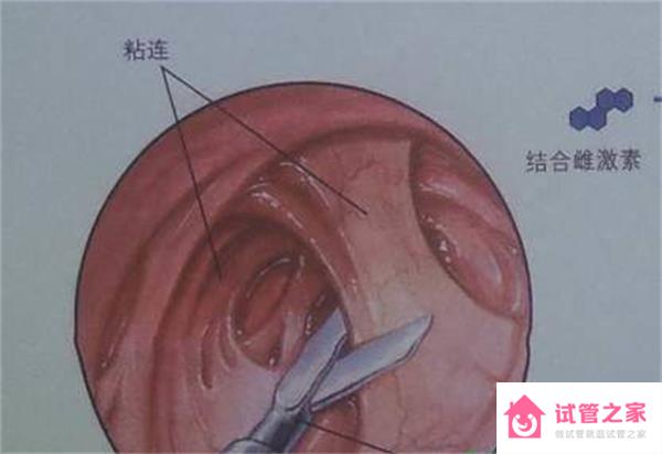 手術(shù)治療三個(gè)月后可以懷孕