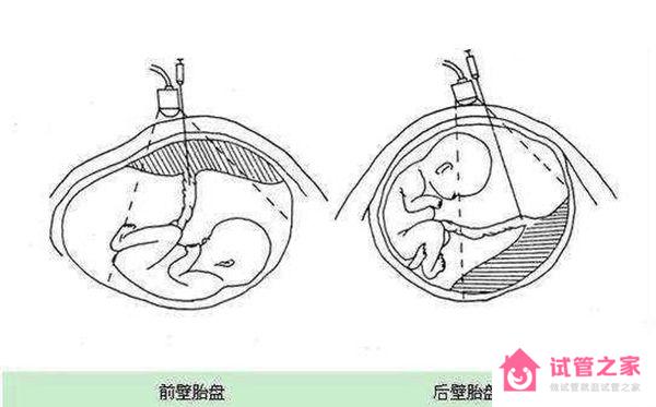 1分鐘了解胎盤前壁和后壁的3大區(qū)別，為孕期做好準備