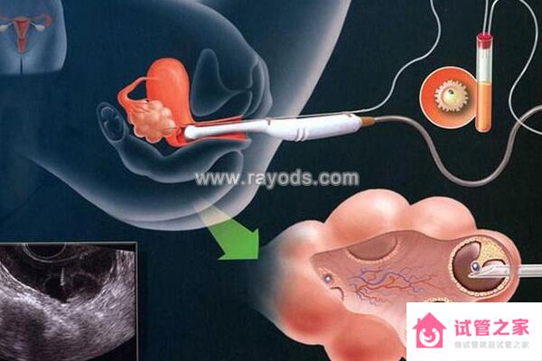 泰國試管嬰兒促排*方案的優(yōu)缺點與適用人群