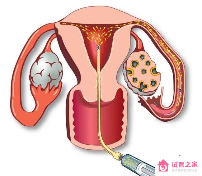 人工授精一般幾次成功