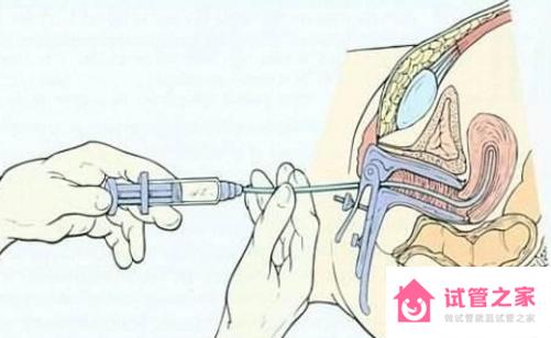 人工授精需要促排、打排*針嗎