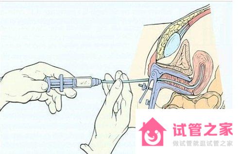 正常情況下做一次人工授精要多少錢