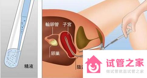 不孕女性做人工受孕痛嗎