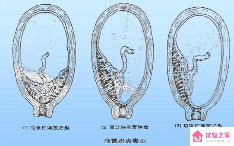 前置胎盤和胎盤早剝差得遠(yuǎn),其中癥狀、原因區(qū)別都很大