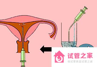 人工授精前注意事項(xiàng)有哪些