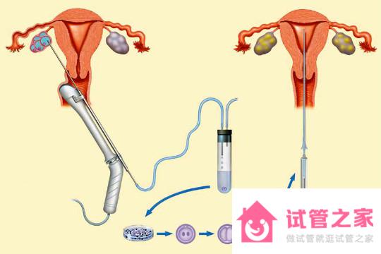 泰國試管嬰兒技術(shù)好在哪里？看完就知道了