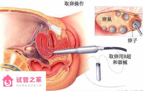 “二孩政策”致浙江試管嬰兒激增，但費(fèi)用和成功率不成正比 ...