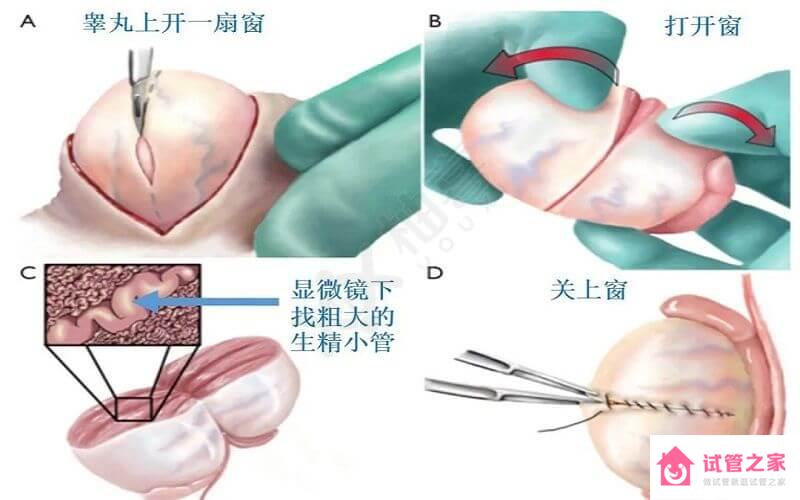 別再疑惑睪丸活檢是怎么做的，答案盡在這3種做法中