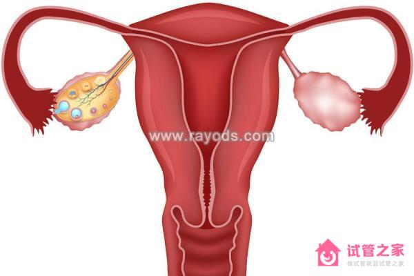 分析子宮腺肌癥去泰國(guó)做試管嬰兒的可行性及成功率