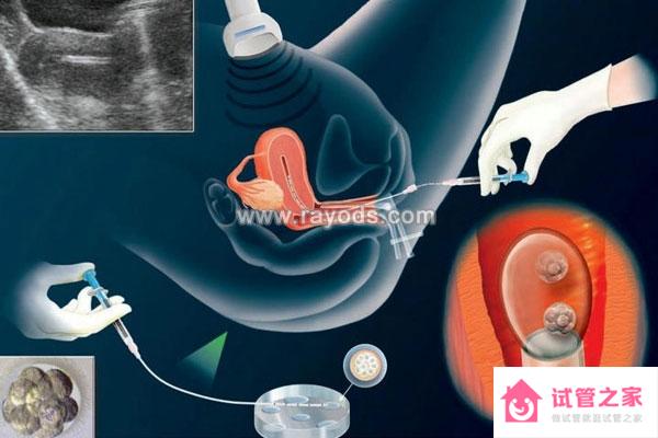 *泡發(fā)育不良由什么原因引起? 3步提升試管嬰兒成功率