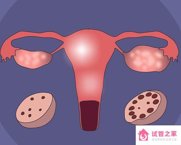 多囊*巢是去常州專科醫(yī)院治療還是找中醫(yī)調(diào)理好呢？