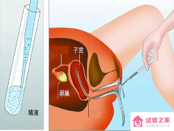 做供精人工授精的條件是什么，適不適合一看便知