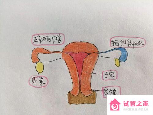 輸*管積水影響試管嬰兒成功率嗎?