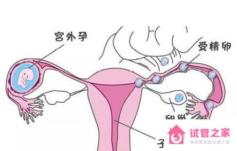 多次宮外孕泰國(guó)試管嬰兒成功率高嗎？