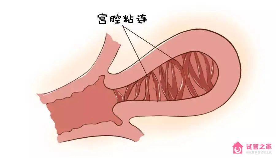 為什么現(xiàn)在胎停的人越來越多？多半與以下4個因素有關(guān)