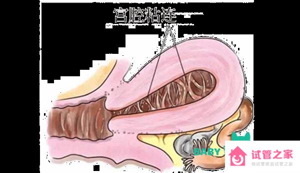 宮腔粘連的治療方法介紹，這三種保守治療方法最常見