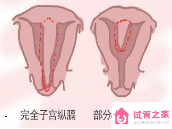 26歲女性縱隔子宮能懷孕嗎？