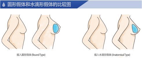 水滴型假體隆胸和圓形假體隆胸哪個(gè)好？那些人適合什么？