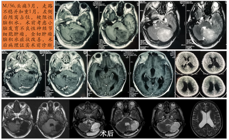 小腦發(fā)育不良性神經(jīng)節(jié)細胞瘤（LDD）的診治