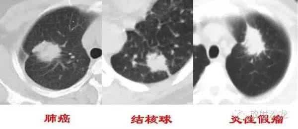 肺部結節(jié)的形成有哪些原因