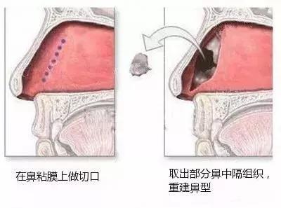 自體軟骨隆鼻的效果好不好？