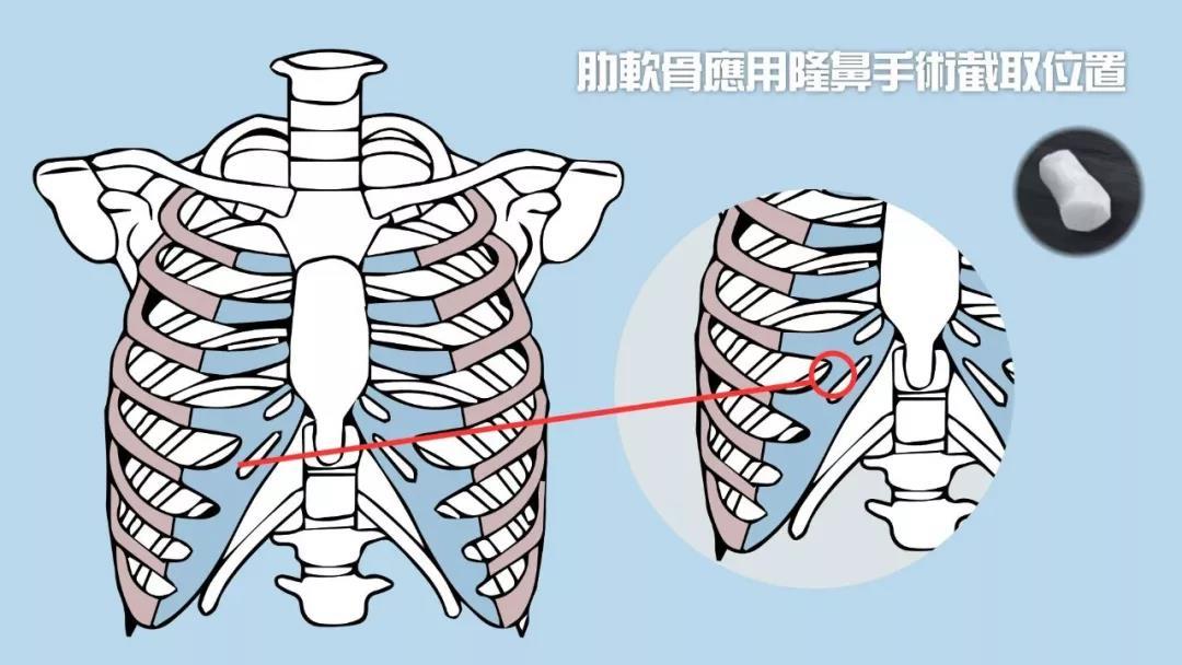 自體軟骨隆鼻的效果好不好？