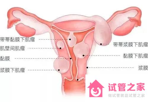 1／4的不孕均與子宮肌瘤有關(guān)，若月經(jīng)量多就得小心了！