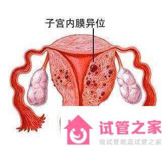 子宮內(nèi)膜異位癥可以做試管嬰兒嗎？