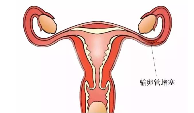 輸*管堵塞情況不同，對(duì)試管嬰兒成功率的影響也不同！