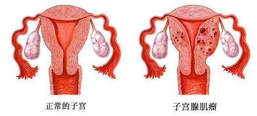 子宮腺肌瘤會影響懷孕不？