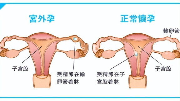 宮外孕是怎么一回事？很嚴(yán)重嗎？