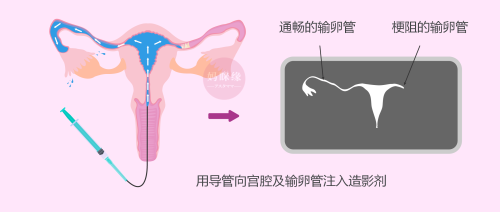 檢查輸*管是否通暢，選擇通液還是造影呢？