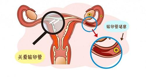 怎么知道輸*管堵了？