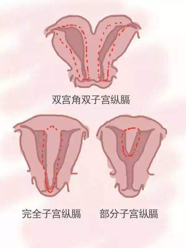 幼稚子宮與始基子宮能懷孕嗎？