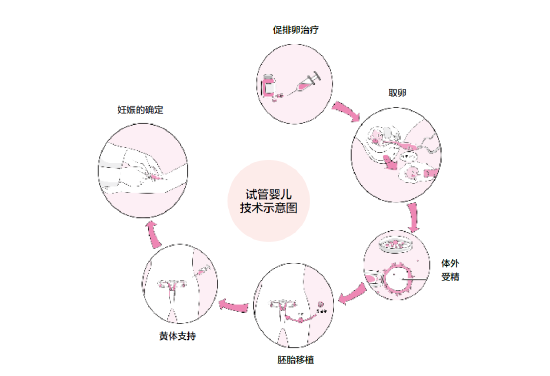 輸*管不通？這該怎么治療？