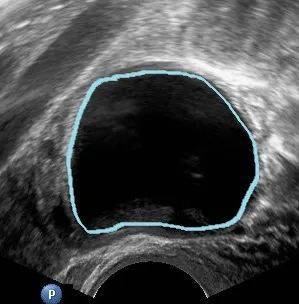 B超如果這么描述，*巢囊腫就可能是惡性的！