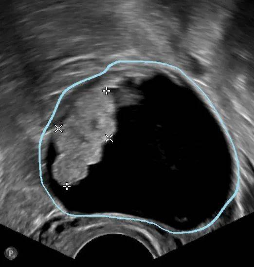 B超如果這么描述，*巢囊腫就可能是惡性的！