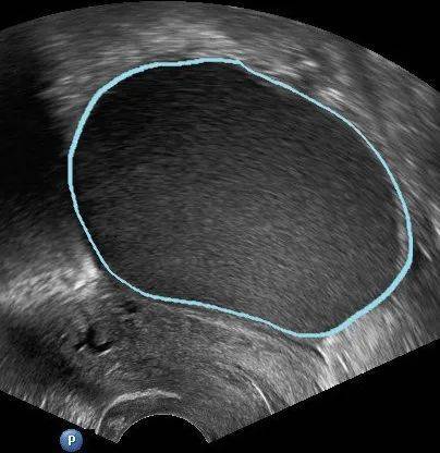 B超如果這么描述，*巢囊腫就可能是惡性的！