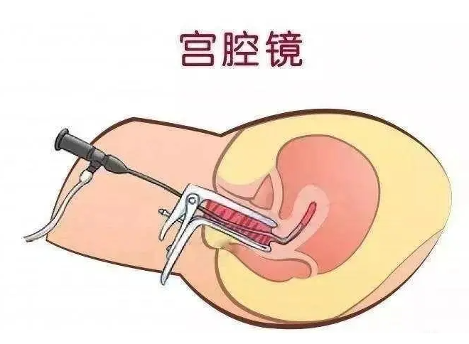 為什么要做腹腔鏡和宮腔鏡檢查？