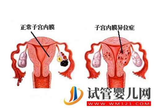 子宮內(nèi)膜異位癥有這4種類型,難怪癥狀不一樣