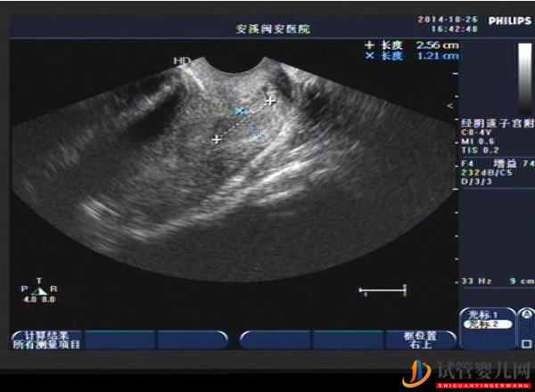 amh值0.35調(diào)理正常懷孕有點難