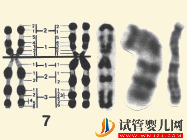 7號染色體異常真不是騙局，出現(xiàn)三體、偏多孩子會有這些疾病 ...