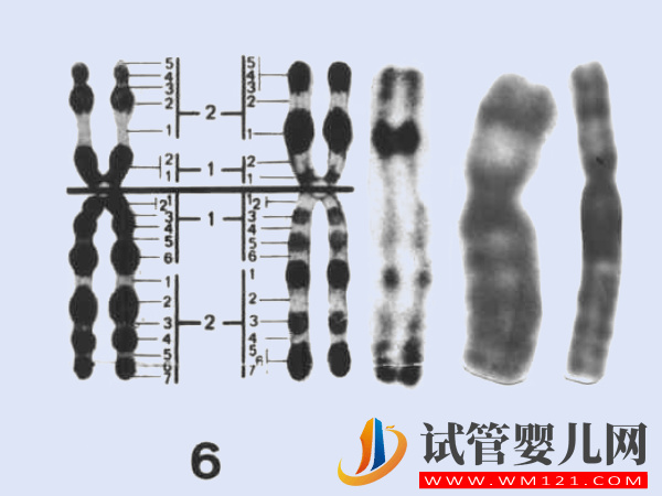 6號染色體缺失、重復相關疾病匯總，不同異常對寶寶影響不一 ...