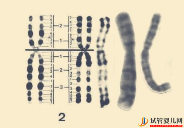 2號染色體異常的后果 - 三體、部分缺失胎兒癥狀表現(xiàn)整理